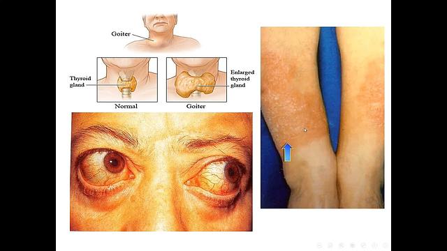 Hyperthyroidism Drugs