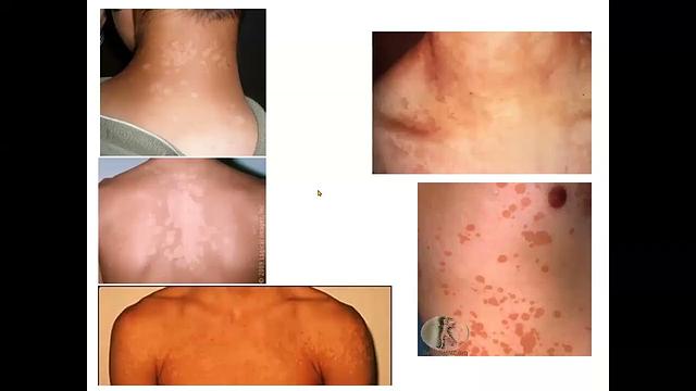 Antifungals 2-AmB, Nystatin, & Flucytosine