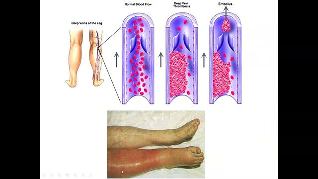 Anticoagulants 2-Heparin and LMWHs